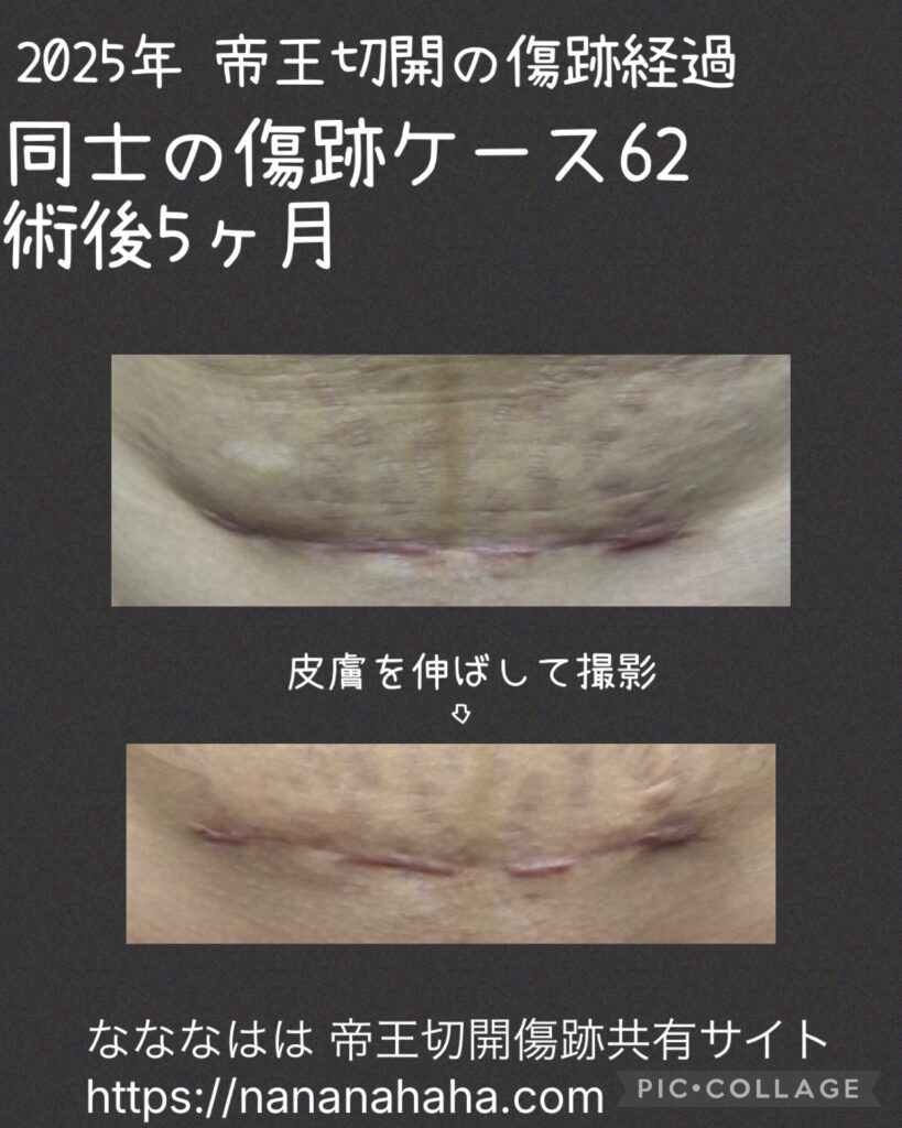 同士の傷跡62・5ヶ月