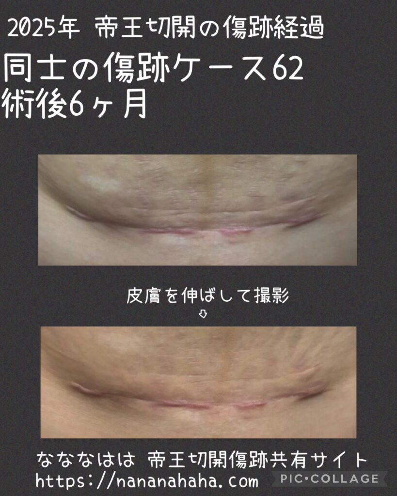同士の傷跡62・6ヶ月