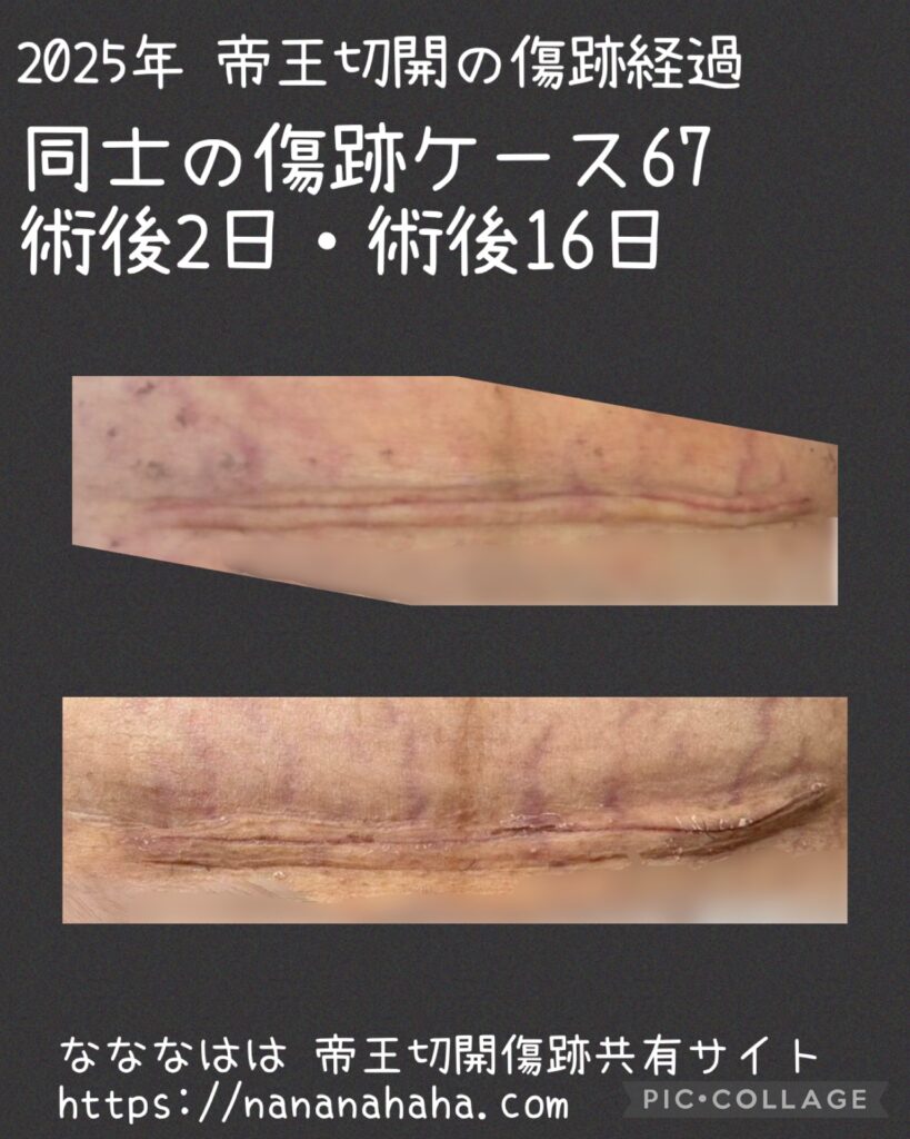 同士の傷跡67・術後2日・16日