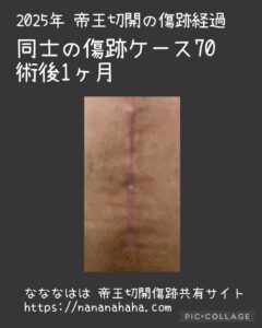 同士の傷跡70・術後1ヶ月