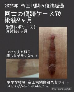 同士の傷跡70・術後9ヶ月(注射後2ヶ月)