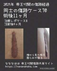 同士の傷跡70・術後11ヶ月(注射後4ヶ月)
