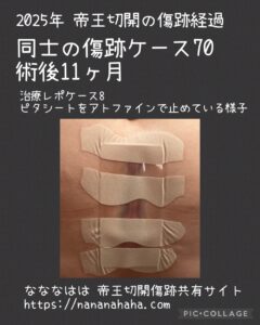 同士の傷跡70・術後11ヶ月ピタシート