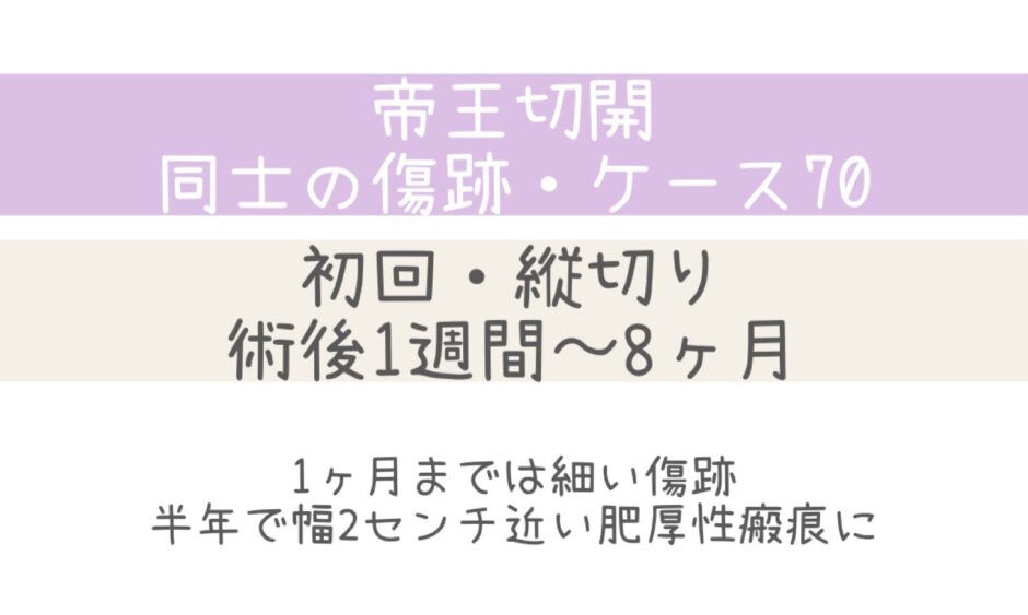 同士の傷跡70・術後1週間～8ヶ月半